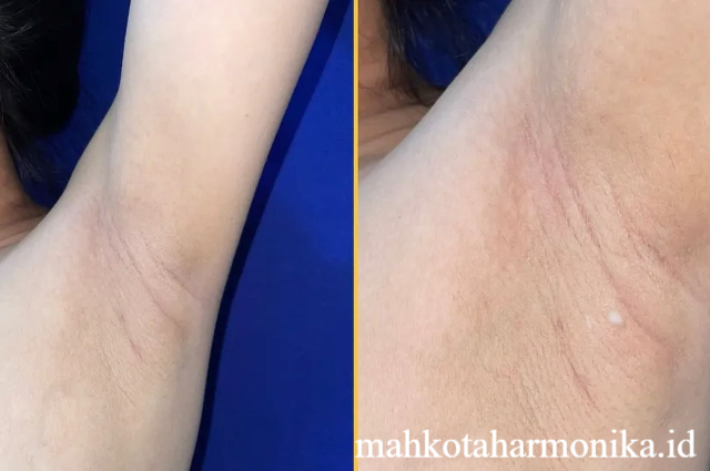 Keluarnya ASI dari Ketiak, Ini Penjelasan Dokter